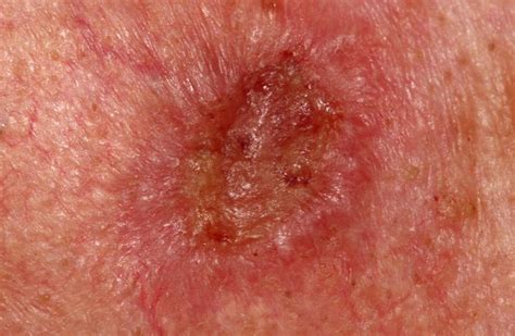 Squamous Cell Carcinoma Scc Ballarat Skin Cancer Centre