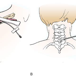 Placement For Continuous Blockade With A Brachial Plexus Catheter My