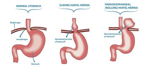 Penyebab Dari Penyakit Hernia Hiatus Dan Cara Mengatasinya
