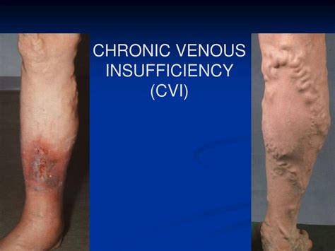 What Is Chronic Venous Insufficiency Know The Symptom