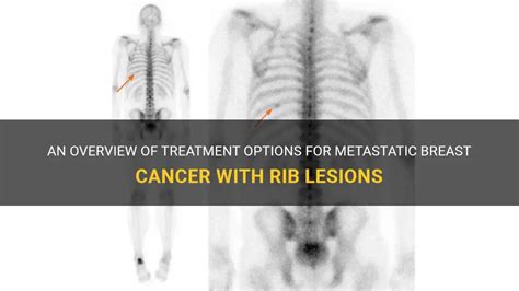 An Overview Of Treatment Options For Metastatic Breast Cancer With Rib