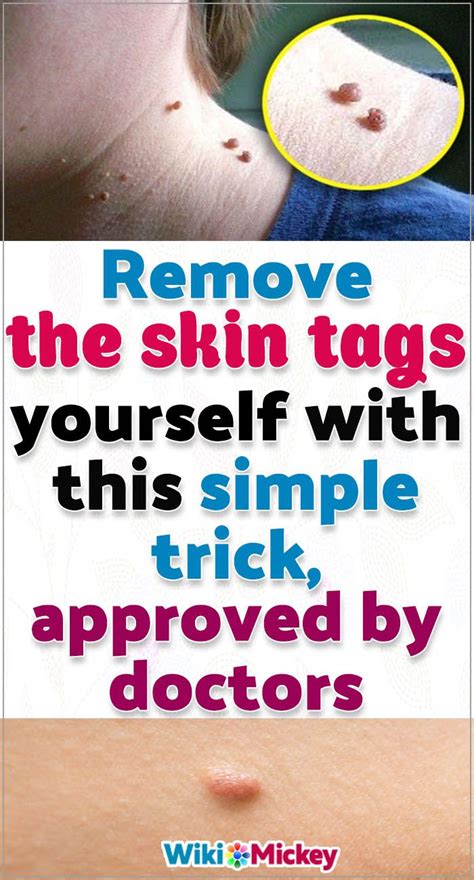 remove the skin tags yourself with this simple trick approved by doctors skin tag skin