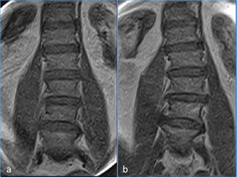 Figure 1 From Lumbar Spine Mri In Upright Position For Diagnosing