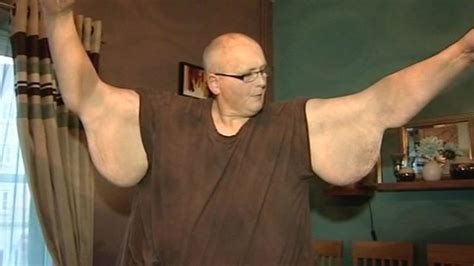 Surgery Hope As Worlds Fattest Man Sheds 46 Stone Bbc News