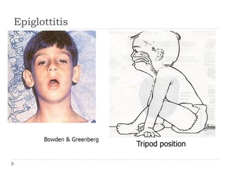 Acute Epiglottitis Smarty Pance Flashcards Quizlet