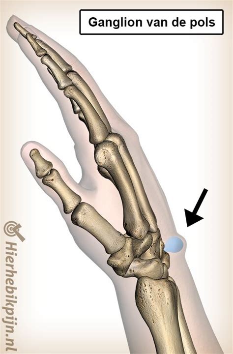Ganglion Van De Pols Oorzaak Symptomen Behandeling