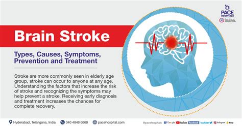 Brain Stroke Types Causes Symptoms Prevention And Treatment