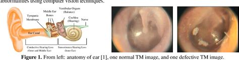 Figure 1 From Detecting Abnormalities In Tympanic Membrane Images