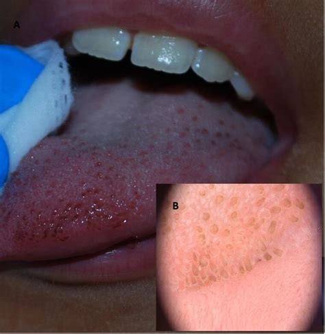 Oral Pigmentation In Children A Diagnostic Challenge Archives Of