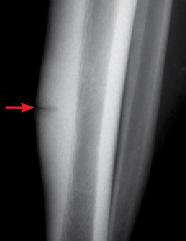 Fratura de estresse da tíbia. Radiografia simples de ...