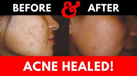 Red Light Therapy Before And After For Acne Phototherapy Youtube