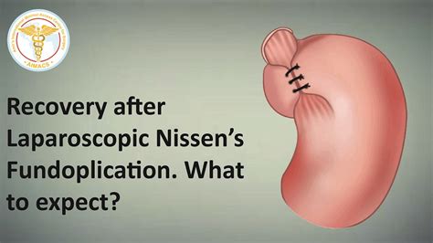 Recovery After Laparoscopic Nissens Fundoplication What To Expect