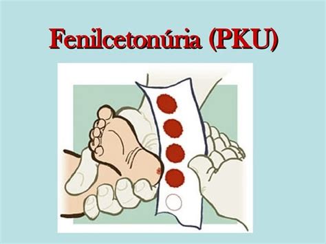 Sindrome Fenilcetonuria