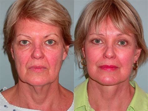 Scar removal before and after. Brow Lift Santa Rosa - Facial Cosmetic Surgery | Artemedica