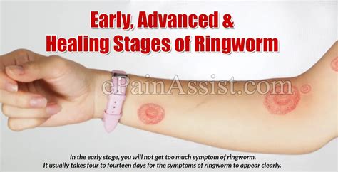 ringworm stages of healing pictures a comprehensive guide claire trend