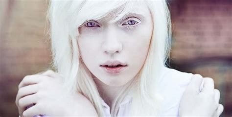 Albinism Albino