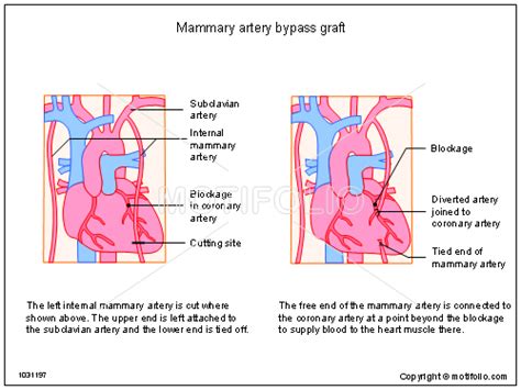 Mammary Artery Bypass Graft Illustrations