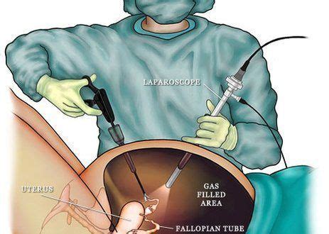 Pdf | uterine leiomyomas or fibroids are the most common neoplasm of the uterus. What is laparoscopic surgery for fibroid uterus? # ...
