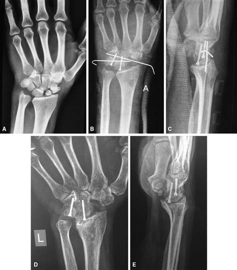Four Corner Fusion Of The Wrist Clinical And Radiographic Outcome Of Patients Springerlink