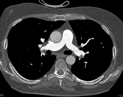 Extensive Pulmonary Embolism Chest Case Studies Ctisus Ct Scanning
