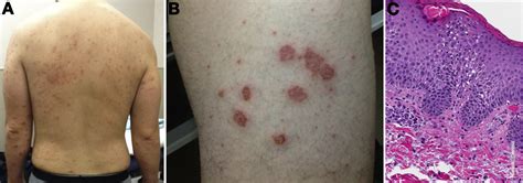 An Unusual Skin Manifestation In A Patient With Ulcerative Colitis