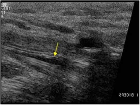 Distal Biceps Rupture Ultrasound