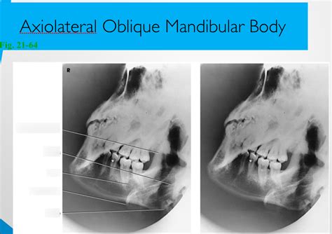 Axio Lateral Oblique Mandibular Body X Ray Anatomy Diagram Quizlet