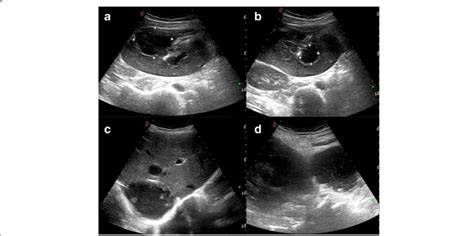 A Right Lobe Liver Abscess B Left Lobe Abscess C Localized Collection