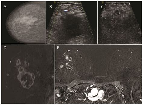 Diagnostic Accuracy Of Mr Mammography In Comparison With Digital
