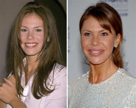 Plastic Surgery Gone Wrong 15 Worst Celebrity Plastic Surgery