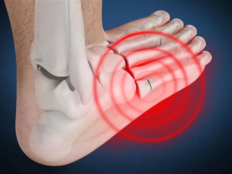 The pain would range from severe to mild, and it. Jones fracture: Causes, symptoms, and treatment