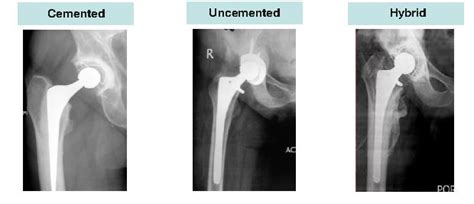 What Are The Types Of Artificial Hip Joints Dr Shekhar Agarwal