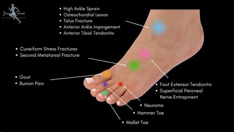 Foot Pain Chart Top Of Foot Side And Front Of Foot Pain Chart