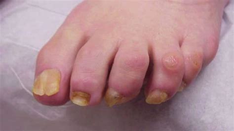 Fungal fingernails and toenails, also known as onychomycosis or nail fungus, may appear discolored, flaky, and thickened. What Treatments Work for Toenail Fungus | Angie's List