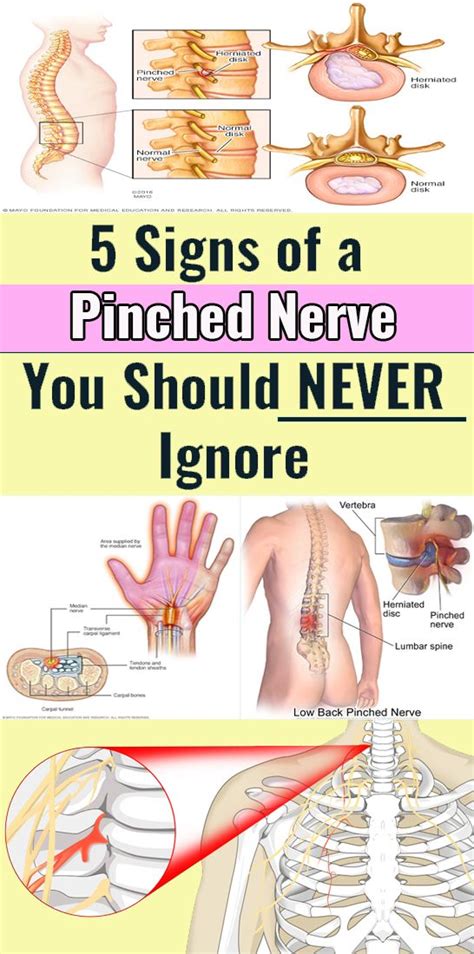 4 Crucial Signs Of A Pinched Nerve Health And Fitness Tips Health