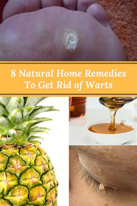 8 Natural Home Remedies To Get Rid Of Warts Home And Gardening Ideas