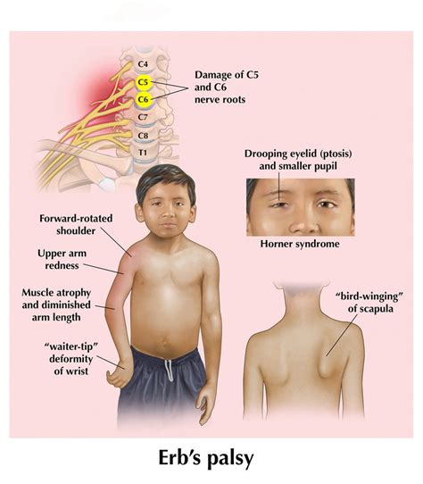 Shoulder Dystociaerbs Palsybrachial Plexus Injury Hospital Neglect