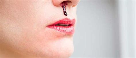 Hidung berdarah, juga dikenali sebagai epistaxis, ialah kejadian biasa pendarahan dari hidung. 10 Punca Hidung Berdarah Wajib Kita Tahu! - Bidadari.My
