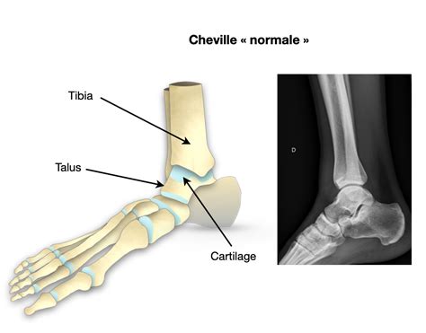 Arthrose De La Cheville Dr Bovier Lapierre