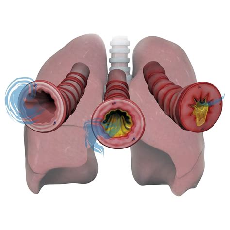 Lungs And Bronchioles Depicting Asthma Stages Of Inflammation And Mucus