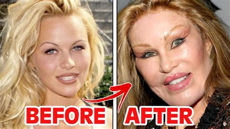 Before And After Botched Celebrity Plastic Surgery Youtube