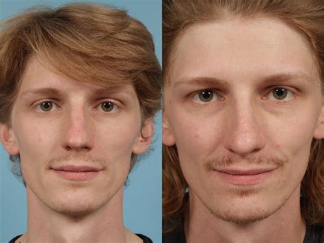 Tlkm showed a head and shoulders pattern on january 28, 2020. Rhinoplasty by Dr. Mustoe Before & After Photos Patient ...