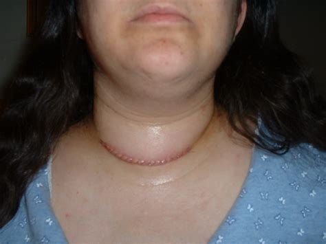 Poppetree Scar From Thyroidectomy