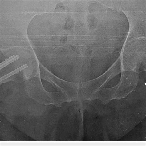 Anteroposterior Both Hip Radiograph With Right Femoral Neck Fracture