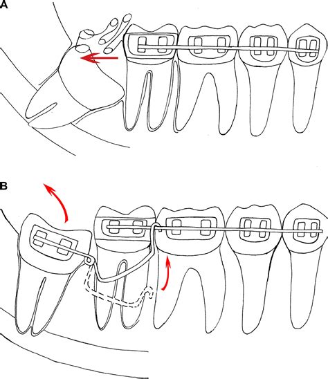 An Orthodontic Technique For Minimally Invasive Extraction Of Impacted