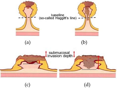 Desmoplastic Reaction In Biopsy Specimens Of T Stage Colorectal Cancer