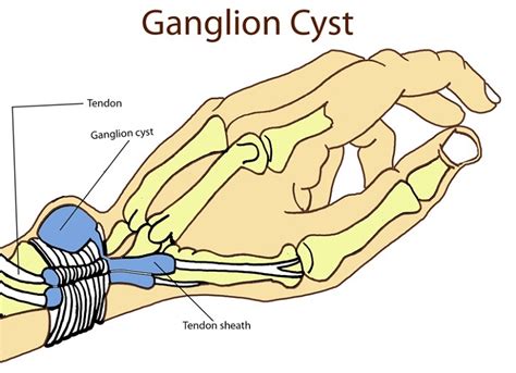 Use the mouse scroll wheel to move the images up and down alternatively use the tiny arrows (>>) on both side of the image to move the images. Ganglion Cyst Symptoms, Removal, Treatment, Surgery