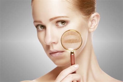 La Guía Completa Del Melasma Clínica Dermatológica Y Estética Doctor