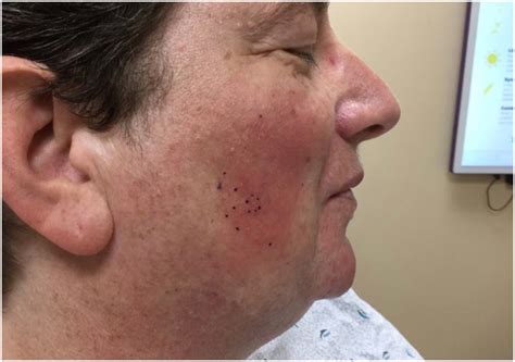 Successful Treatment Of Refractory Subacute Cutaneous Lupus
