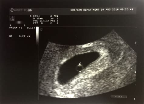 I've discovered that there is a huge difference between *regret* and *guilt*. What's the bleeding story? | Hope After Miscarriage